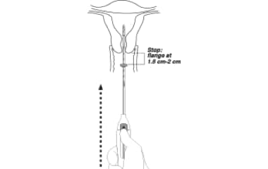 Illustration of Mirena (levonorgestrel-releasing intrauterine system) 52 mg IUD insertion step 4: IUD ready for insertion.