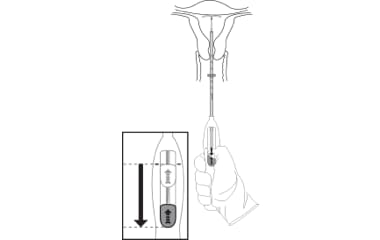 Illustration of Mirena (levonorgestrel-releasing intrauterine system) 52 mg IUD insertion step 7: release and withdraw the inserter.