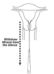 Withdraw Mirena® from the uterus Illustration shows withdrawal of Mirena (levonorgestrel-releasing intrauterine system) 52 mg IUD from the uterus.