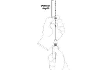 Set the flange Illustration of Mirena (levonorgestrel-releasing intrauterine system) 52 mg IUD insertion step 3: setting the IUD flange.