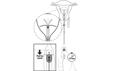 Open the arms Illustration of Mirena (levonorgestrel-releasing intrauterine system) 52 mg IUD insertion step 5: open the arms.