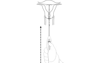 Advance to the fundal position Illustration of Mirena (levonorgestrel-releasing intrauterine system) 52 mg IUD insertion step 6: advance to the fundal position
