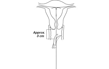 Cut the threads Illustration of Mirena (levonorgestrel-releasing intrauterine system) 52 mg IUD insertion step 8: cut IUD threads.